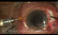 Manejo Integral de Ectopia Lentis por Facofragmentación y Lente Scleral Tuck