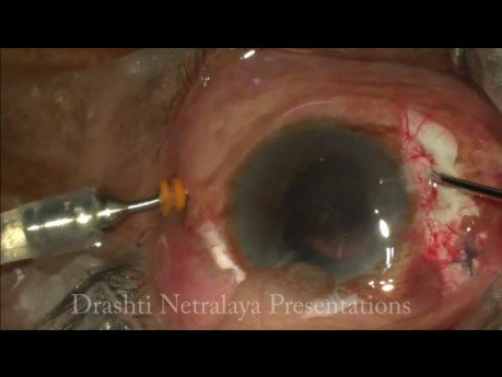 Manejo Integral de Ectopia Lentis por Facofragmentación y Lente Scleral Tuck