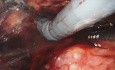 Viabilidad de la adrenalectomía retroperitoneal robótica para lesiones suprarrenales grandes