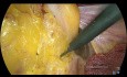 Escisión mesorrectal total laparoscópica (EMTL)