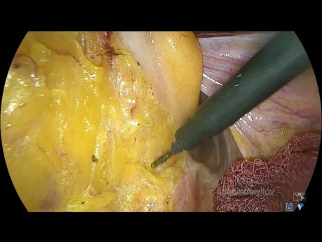 Escisión mesorrectal total laparoscópica (EMTL)