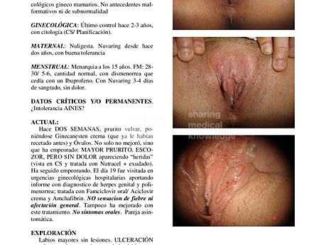 Ulcera Vulvar Aguda de Lipschutz