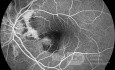 Neovascularización coroidea en un paciente con estrías angioides (angiografía con fluoresceína)