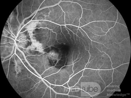 Neovascularización coroidea en un paciente con estrías angioides (angiografía con fluoresceína)