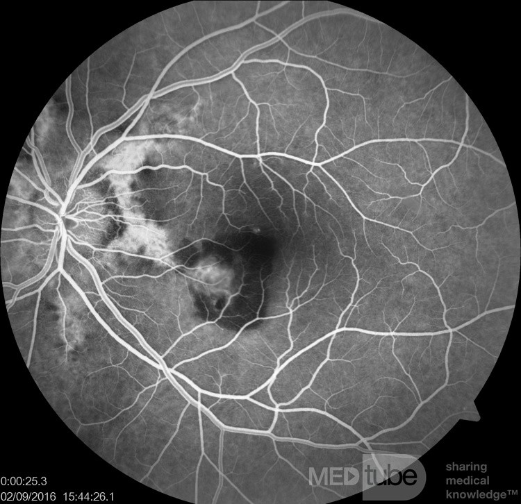 Neovascularización coroidea en un paciente con estrías angioides (angiografía con fluoresceína)