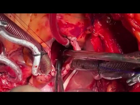 Paciente con cierre previo con Amplatzer con defecto septal atrial (DSA), defecto septal ventricular (DSV) y fallo del ventrículo derecho (VD)