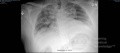 Radiografía de tórax - COVID-19 (2)