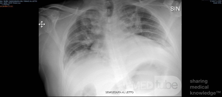 Radiografía de tórax - COVID-19 (2)