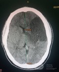 Craniectomía descompresiva en infarto maligno de la arteria cerebral media