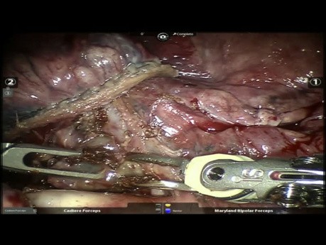 Cirugía robótica de pulmón después de la terapia neoadyuvante