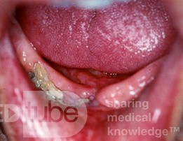 Osteonecrosis por radiación [mandíbula]