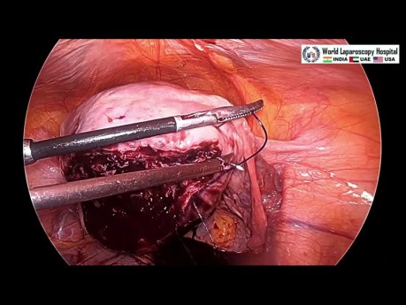Manejo laparoscópico del fibroma intramural posterior