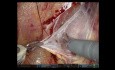 SAFE (Exposición fascial asistida con solución salina) para la preservación de nervios durante la RARP