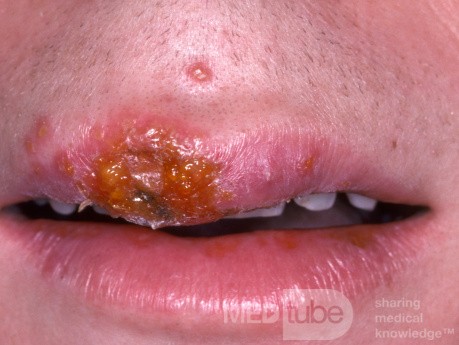 Herpes simple temprano en el labio superior