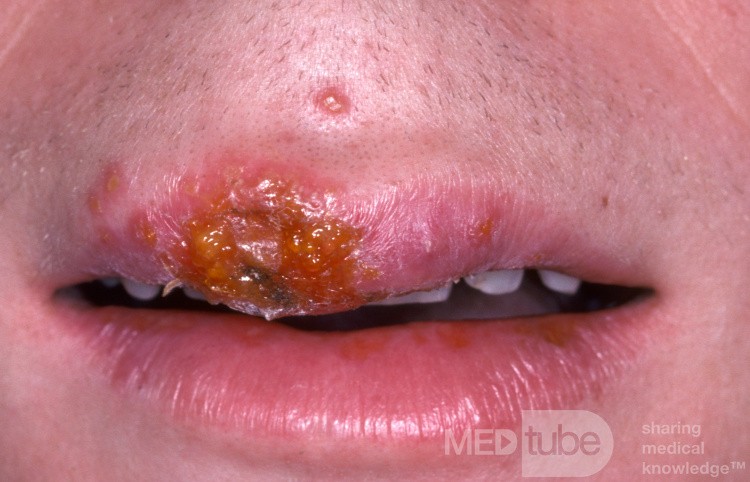 Herpes simple temprano en el labio superior