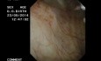 Neoformación vesical en el meato ureteral derecho