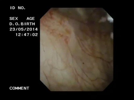 Neoformación vesical en el meato ureteral derecho