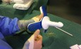 Tratamiento de Hemorroides Prolapsados con Técnica no Escisional