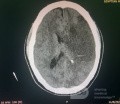 Craniectomía descompresiva en infarto maligno de la arteria cerebral media