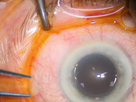 Reemplazo de dos lentes calcificadas, 5 años después de la implantación