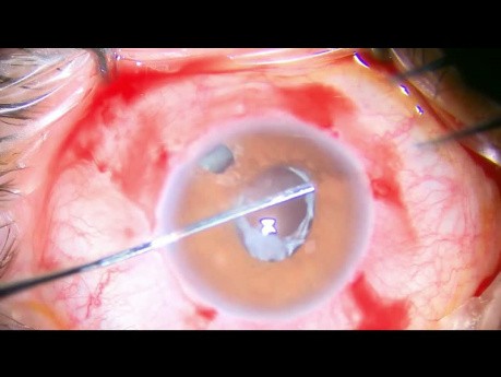 Implantación de lente secundaria con fijación adicional de retina
