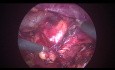 Cirugía laparoscópica retroperitoneal para extirpar un tumor renal