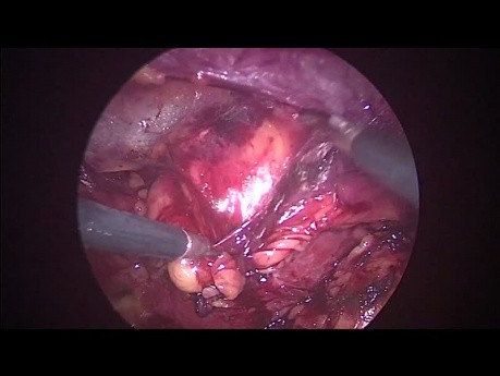 Cirugía laparoscópica retroperitoneal para extirpar un tumor renal
