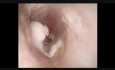 Otomicosis del oído izquierdo