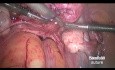 Ligadura temporal de la arteria uterina mediante el nudo de "cordón de zapato" antes de la miomectomía por laparoscopia