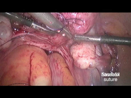 Ligadura temporal de la arteria uterina mediante el nudo de "cordón de zapato" antes de la miomectomía por laparoscopia