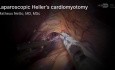 Cardiomiotomía de Heller laparoscópica