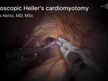 Cardiomiotomía de Heller laparoscópica