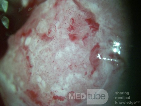 Colposcopia - Carcinoma de células escamosas invasivo