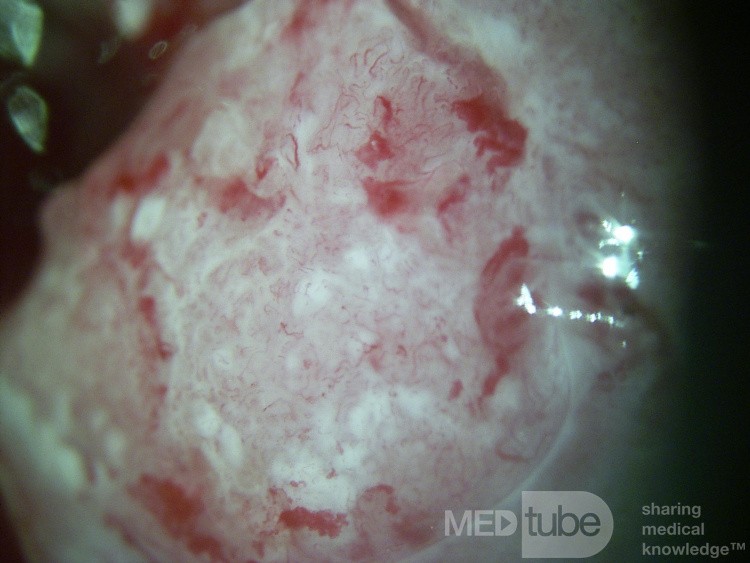 Colposcopia - Carcinoma de células escamosas invasivo