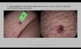 Vulva Tumor Vestibulo Uretral Excision y Colgajo