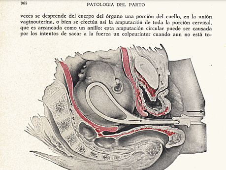 De Lee Accidentes Del Parto