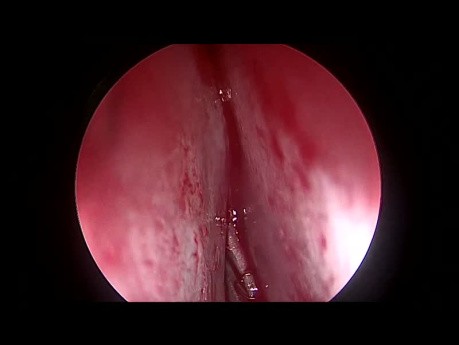 Septoplastia endoscópica para la desviación del tabique