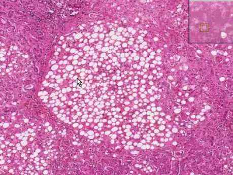 Enfermedad hepática alcohólica - histopatología - hígado