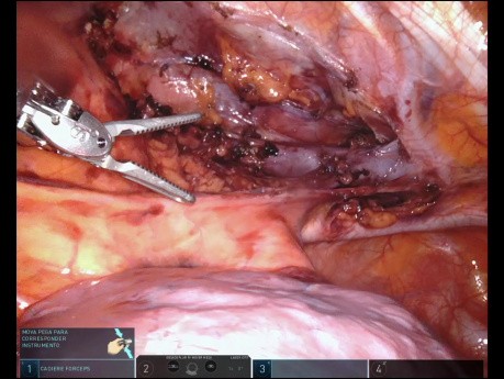 Tumor mediastínico - tiroides ectópica