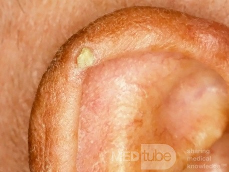 Queratosis solar [Queratosis actínica o queratosis senil]