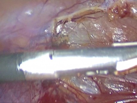 Resección ileocecal por laparoscopia para la enfermedad de Crohn