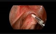 Procedimiento laparoscópico de extracción de Swenson para la enfermedad de Hirschsprung