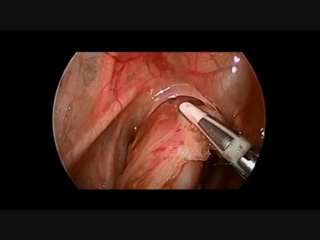 Procedimiento laparoscópico de extracción de Swenson para la enfermedad de Hirschsprung