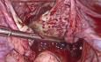 Embarazo ectópico ovárico - embarazo en el ovario
