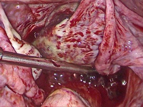 Embarazo ectópico ovárico - embarazo en el ovario