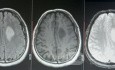Planificación quirúrgica con neuronavegador en paciente con lesión de masa intracraneal. Glioma de alto grado.