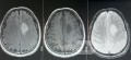 Planificación quirúrgica con neuronavegador en paciente con lesión de masa intracraneal. Glioma de alto grado.