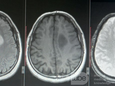 Planificación quirúrgica con neuronavegador en paciente con lesión de masa intracraneal. Glioma de alto grado.