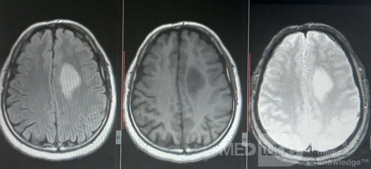 Planificación quirúrgica con neuronavegador en paciente con lesión de masa intracraneal. Glioma de alto grado.