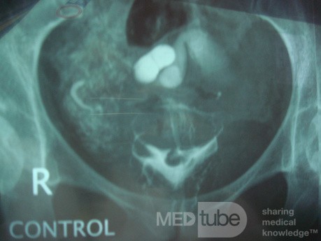 Hidrocele de la trompa de Falopio visto en la HSG